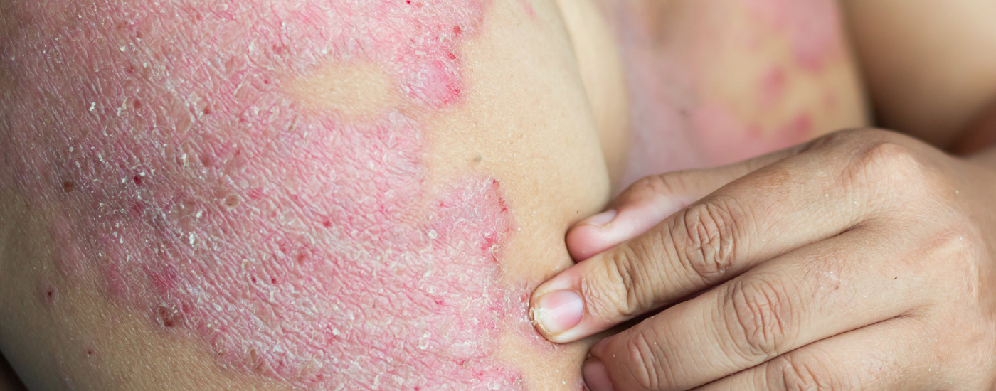 Eczema Examined BioFirst