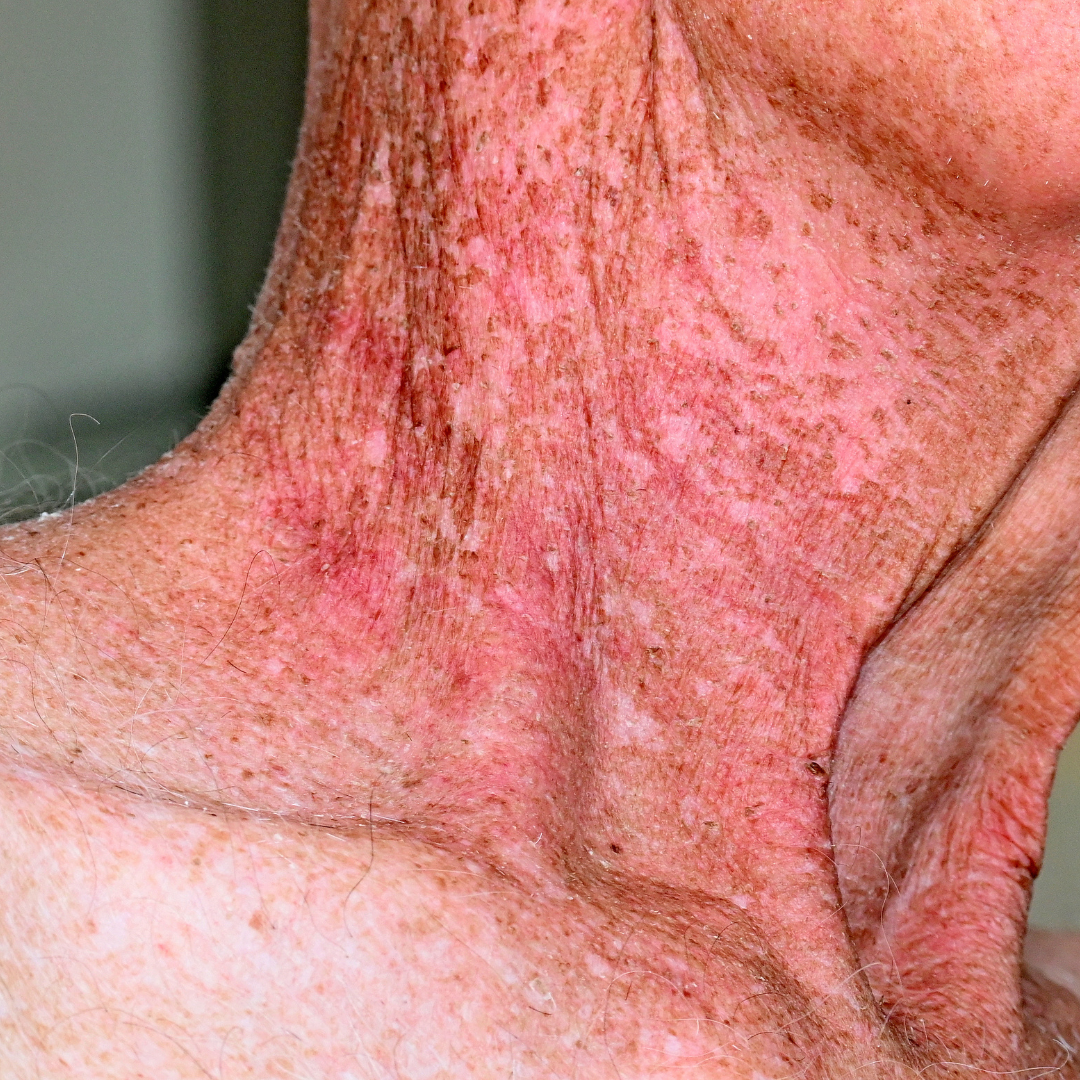 Manuka Skin Saver - Radiotherapy & Oncology Care