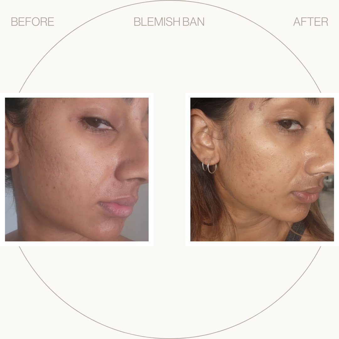 Blemish Ban Gel