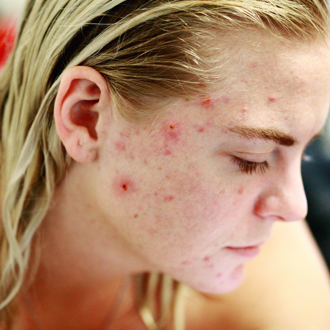 Blemish Ban Toner