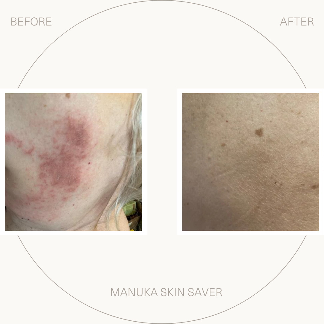 Bio-First Manuka Skin Saver - Psoriasis Prone Skin 50 ml