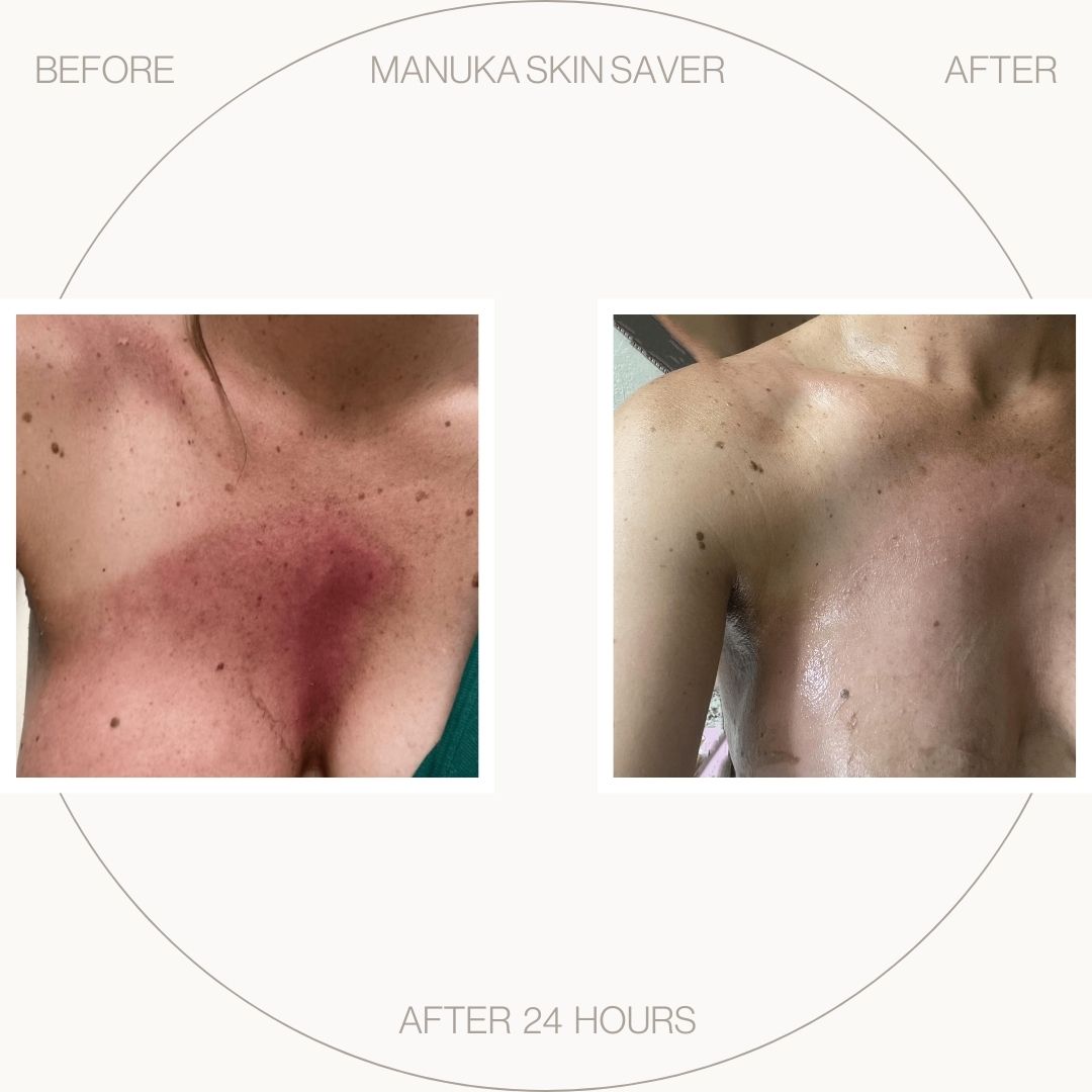 Manuka Skin Saver - Radiotherapy & Oncology Care