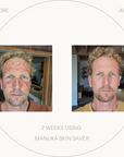 Manuka Skin Saver - Radiation & UV Damage