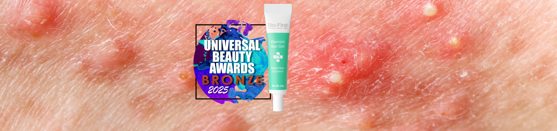 Bio-First’s Blemish Ban Gel takes home a Bronze as the ‘Best Anti Blemish Product’  in the 2025 Universal Beauty Awards