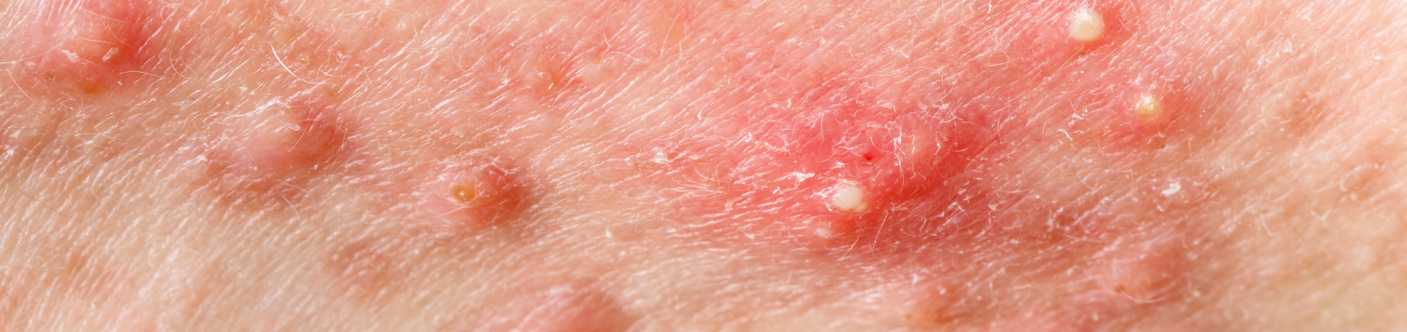 How to Recover from a Salicylic Acid Breakout