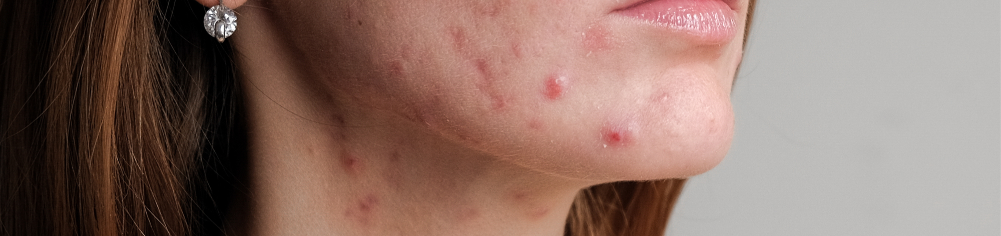 Nature’s Proven Care to Banish Blemishes