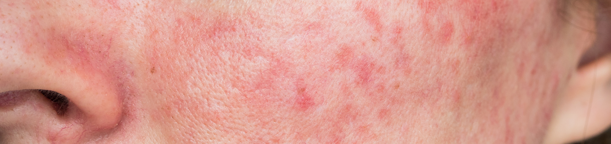 Why Benzoyl Peroxide & Salicylic Acid Based Products Aren’t Great for Your Skin