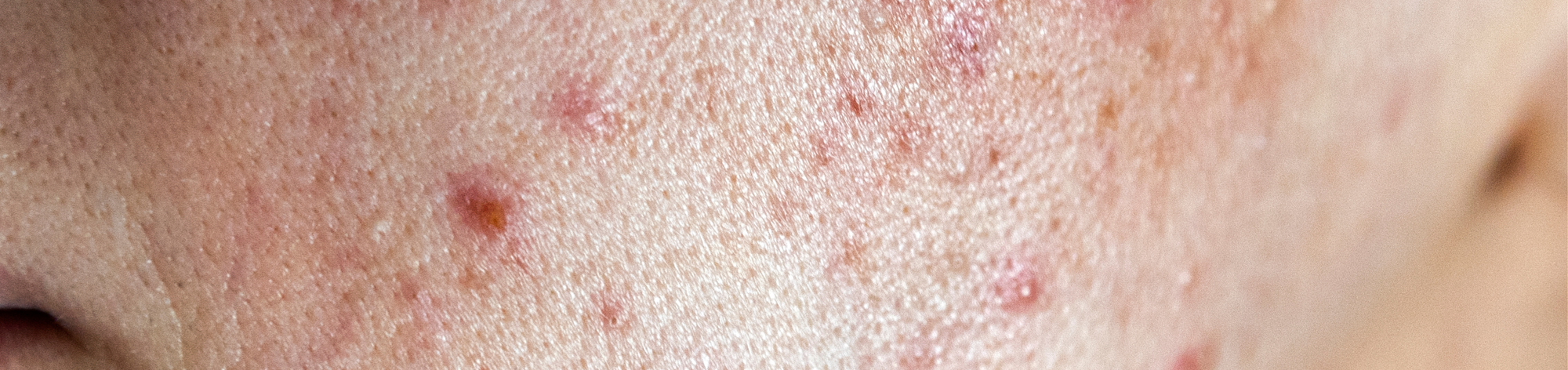 Best Toners for Acne-Prone and Oily Skin