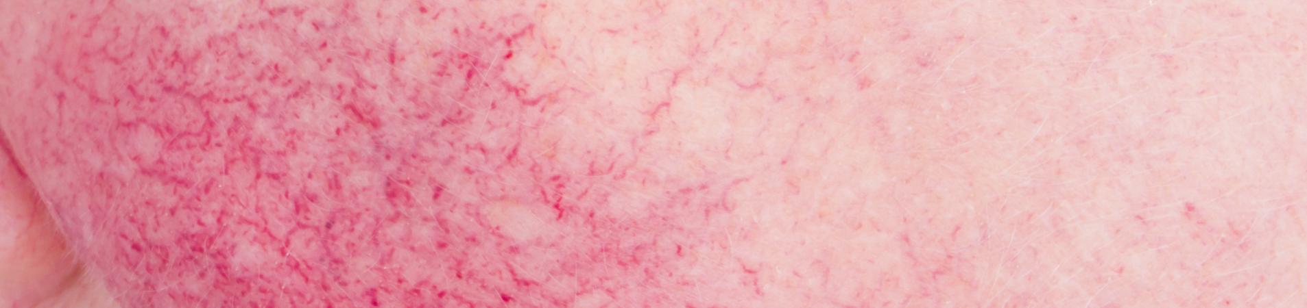 What does Rosacea look like? Bio-first
