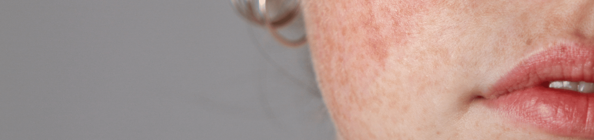 Natural Relief for Rosacea-Prone Skin