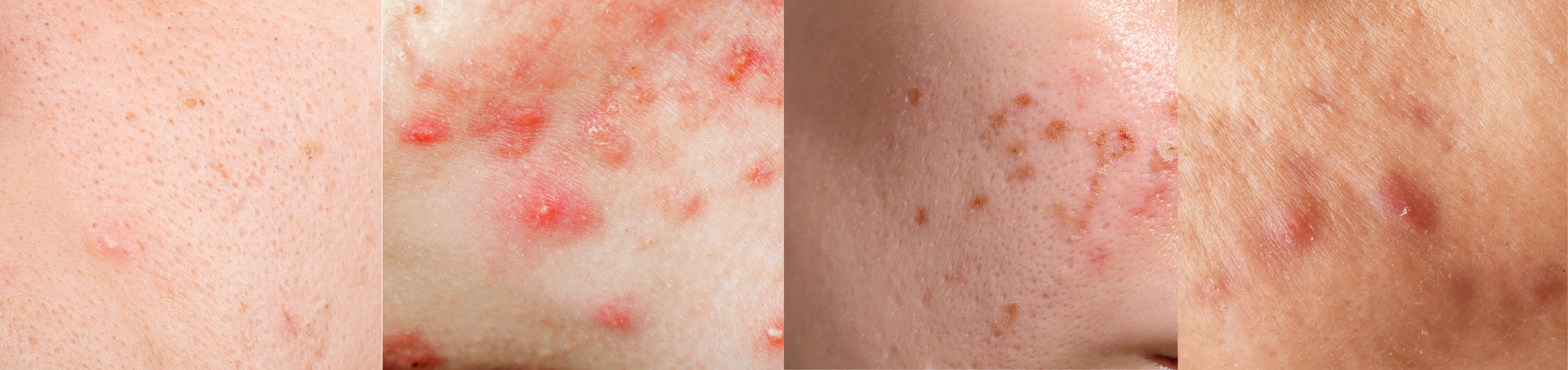 Blemishes, Breakouts, Pimples, Acne: Spot the Difference!