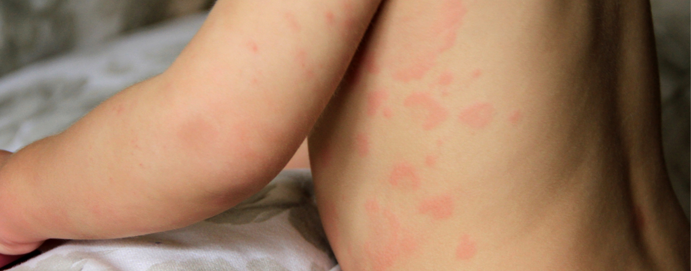 Bio-First Childhood Eczema Skincare: latest evidence