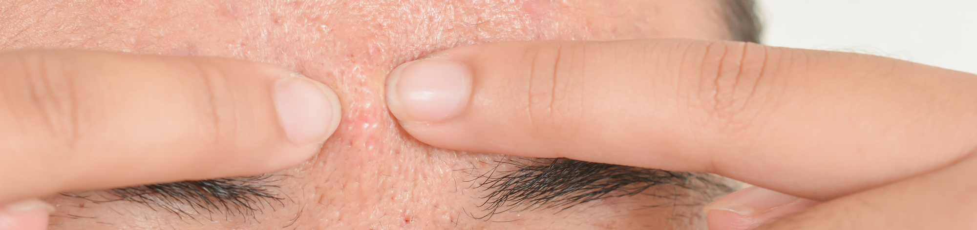 How to Get Rid of Forehead Acne Naturally: A Holistic Approach