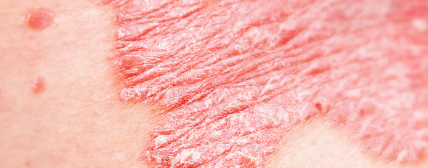 PSORIASIS: Make a Change To How You Care for Your Skin