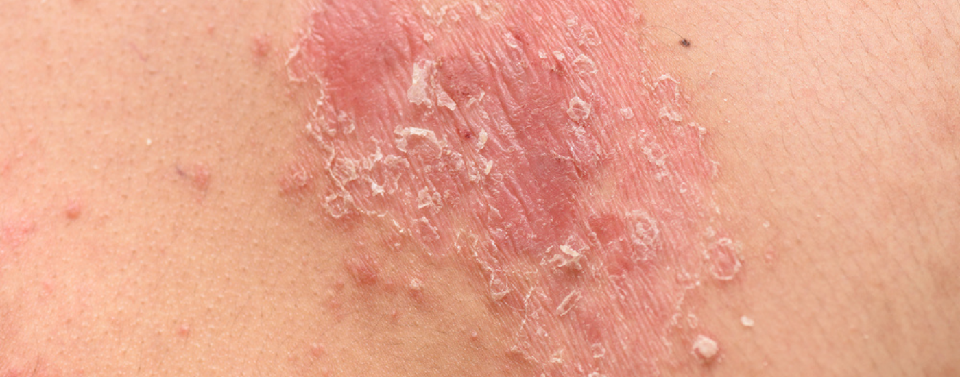 What is Psoriasis and how do you get it?