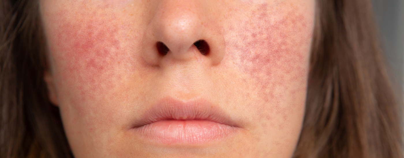 Rosacea on the face/skin - What is Rosacea?