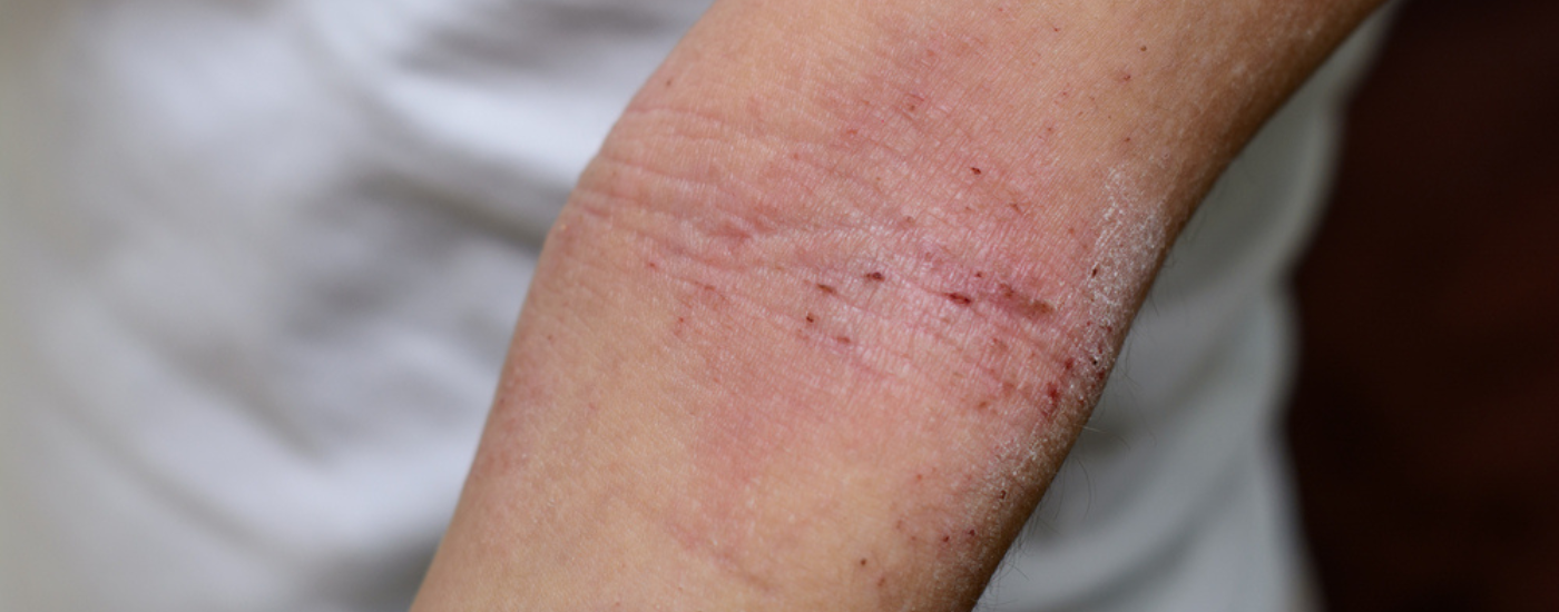 Managing Eczema-Prone Skin Naturally