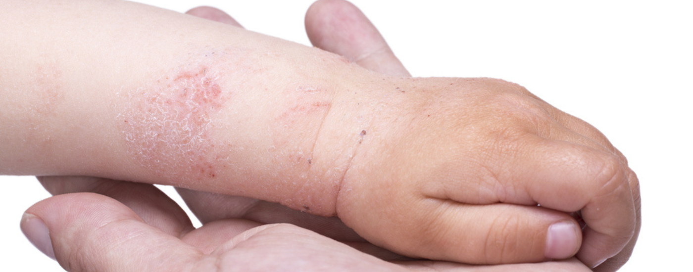 What is Eczema and how do you get it?