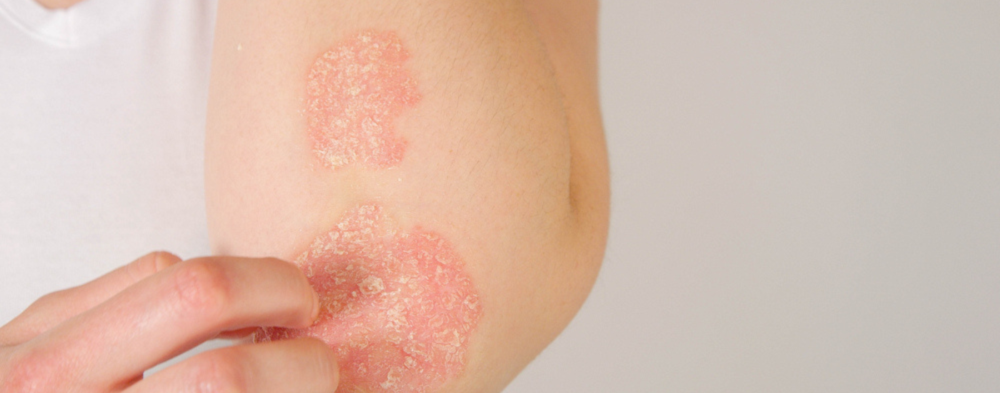 Being prone to Psoriasis and how to manage it naturally