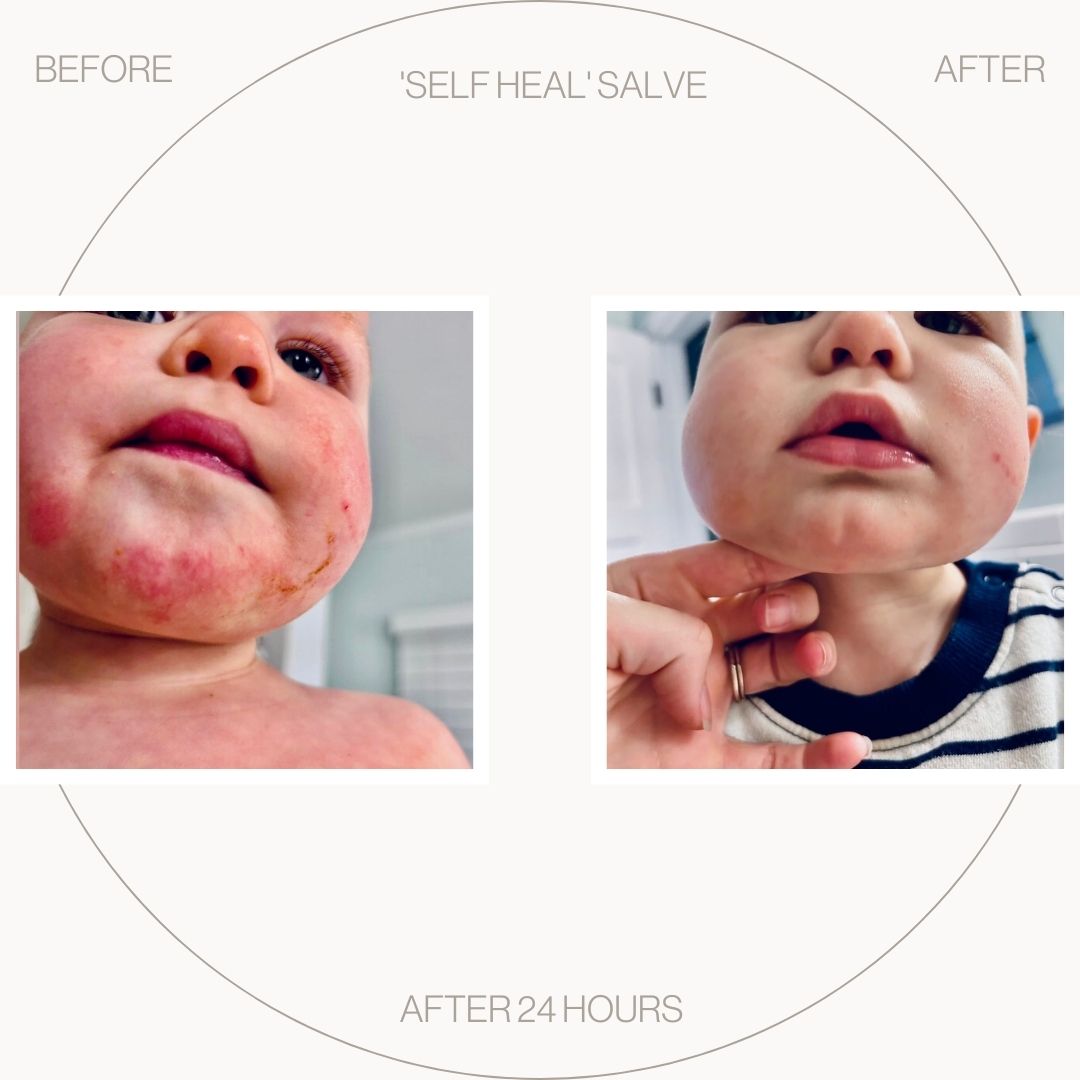 Baby skin, before and after pictures for the Self Heal Salve - Bio-First Products 