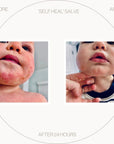 Baby skin, before and after pictures for the Self Heal Salve - Bio-First Products 