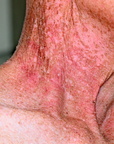 Manuka Skin Saver - Radiotherapy & Oncology Care