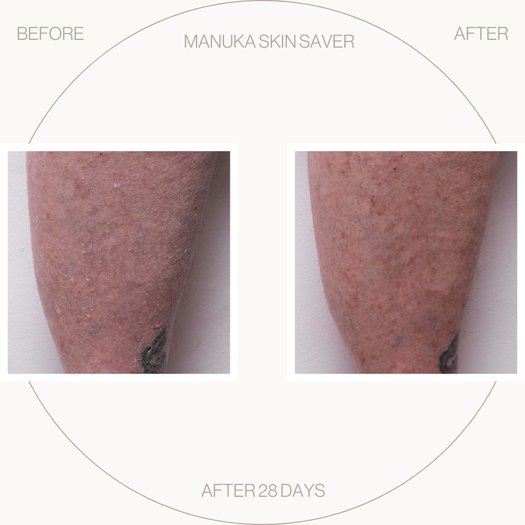 Manuka Skin Saver -  Psoriasis Prone Skin