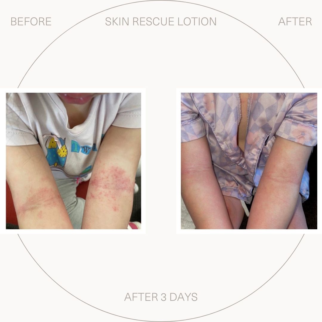 Ezcema on baby, before and after - Healed with Ultrasensitive Skin Rescue Lotion