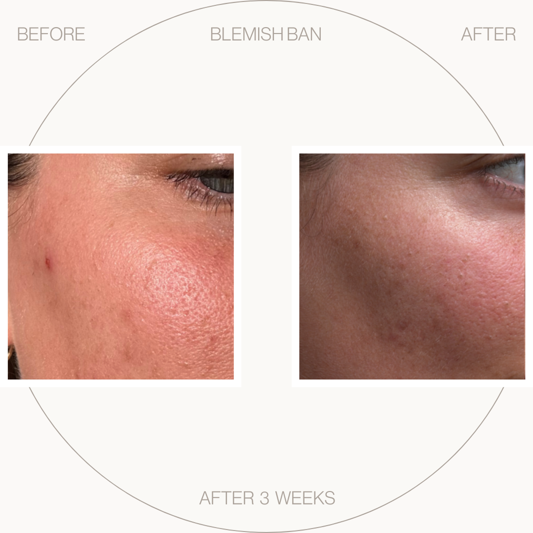 Breakout Rescue Set - Intensive