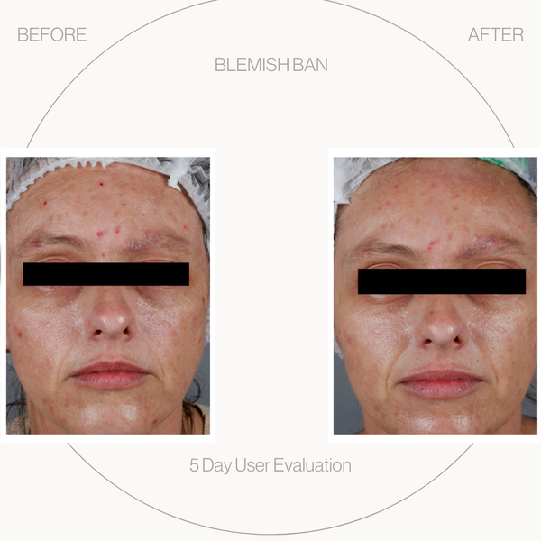 Before and after comparison of facial blemish treatment over five days.