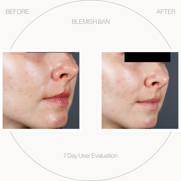 Side-by-side comparison of skin improvement before and after using a blemish product.