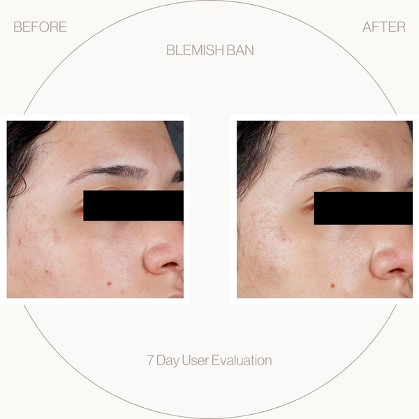 Before and after images of skin treatment for blemishes.