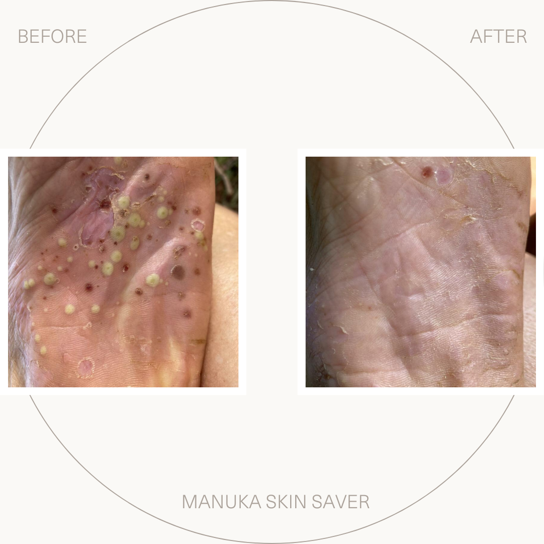 Bio-First Manuka Skin Saver - Psoriasis Prone Skin 50 ml