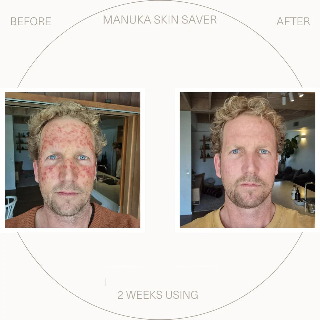 Manuka Skin Saver - Radiation & UV Damage 50 ml