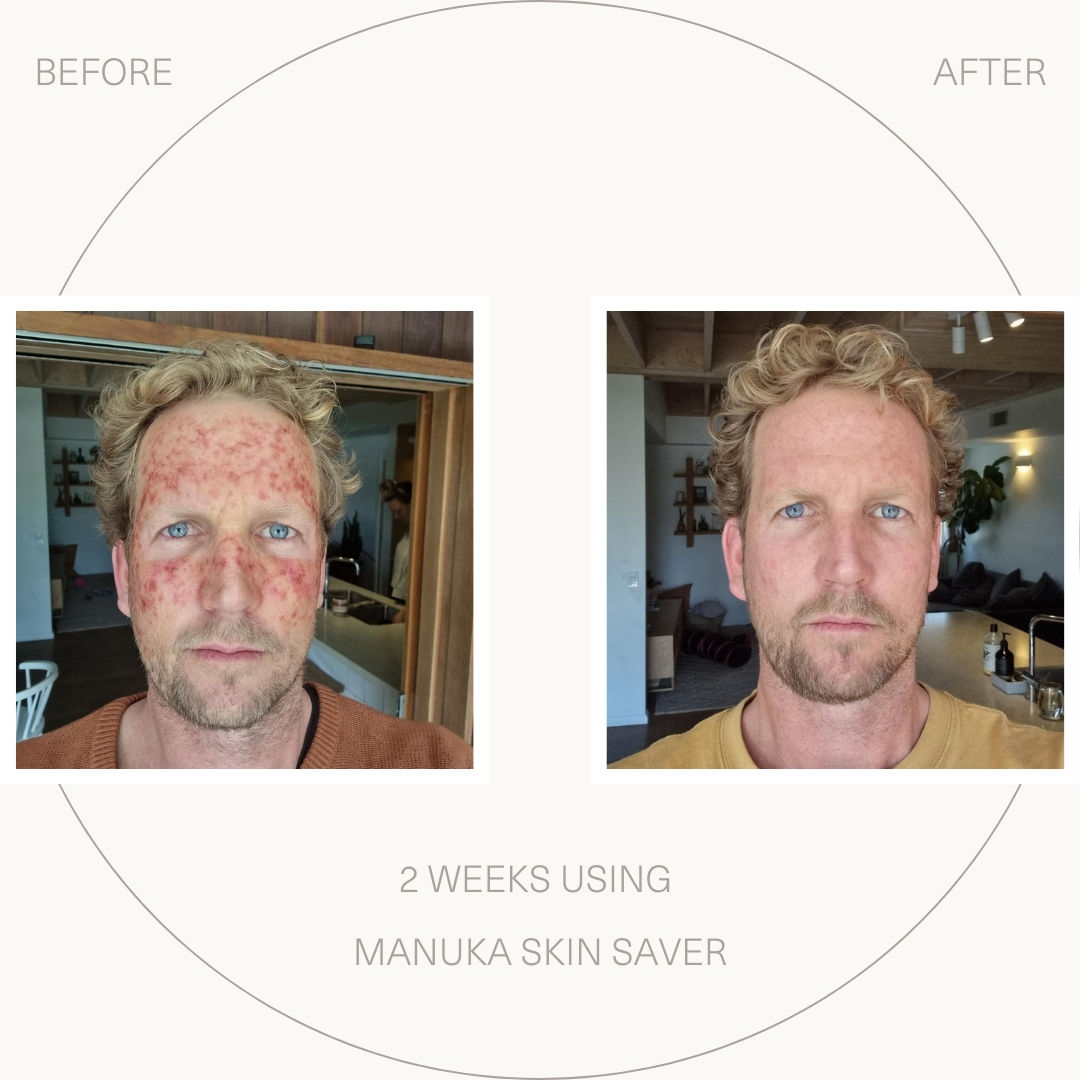 Manuka Skin Saver - Radiation &amp; UV Damage